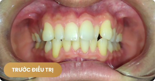 Niềng răng trong suốt