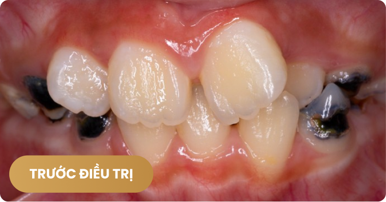 Niềng răng cho trẻ em