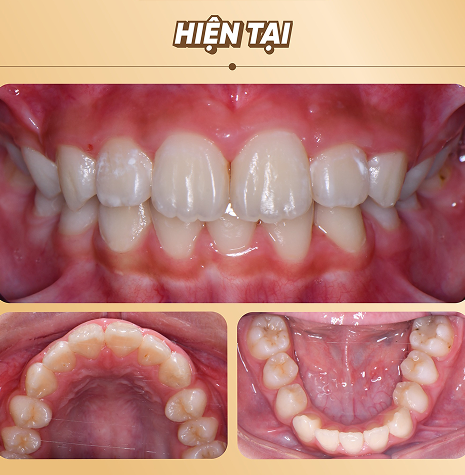 Niềng răng cho trẻ em