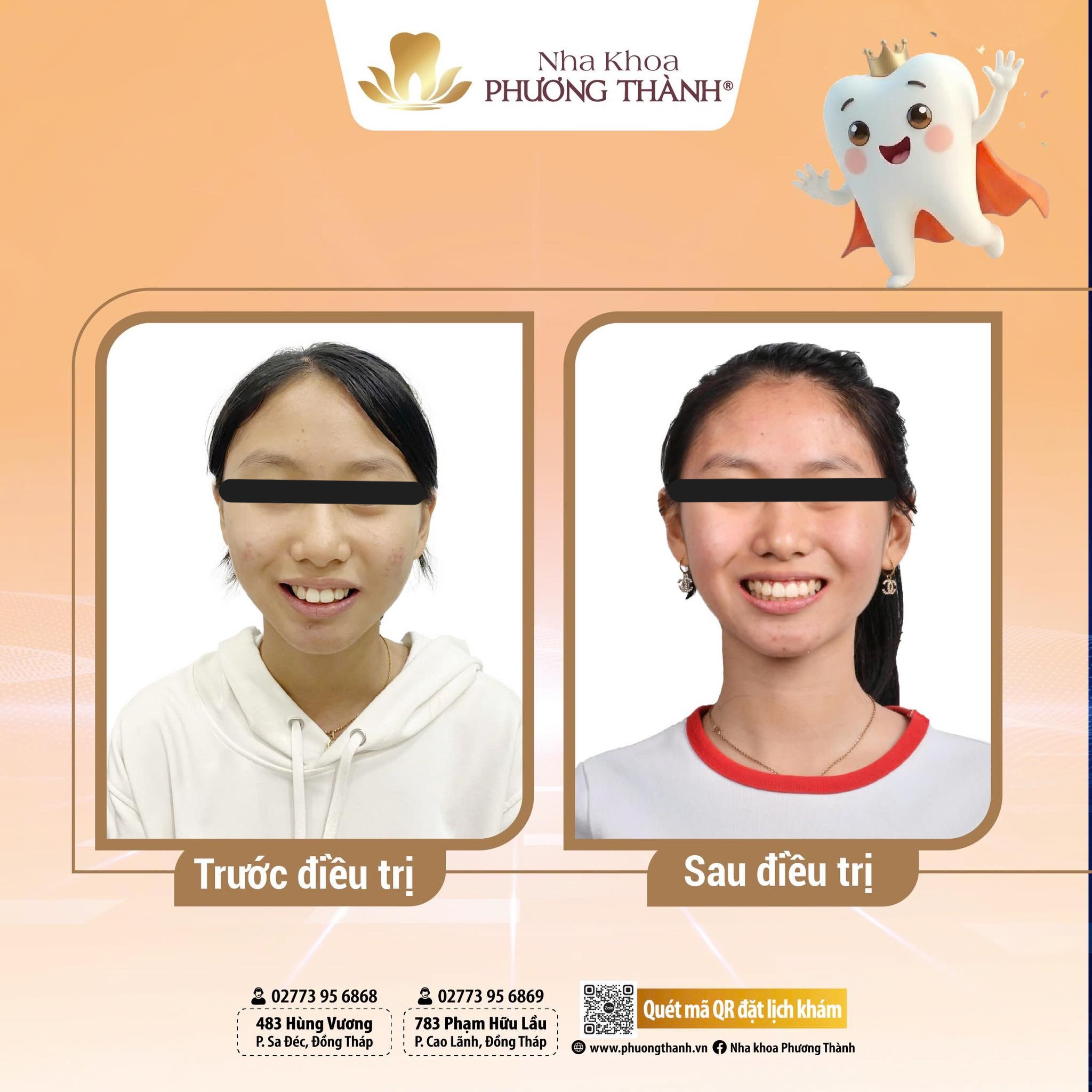 Hành trình tìm lại nụ cười sau chỉnh nha tại Nha Khoa Phương Thành