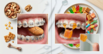 What Should You Eat with Braces? Good Foods & Foods to Avoid