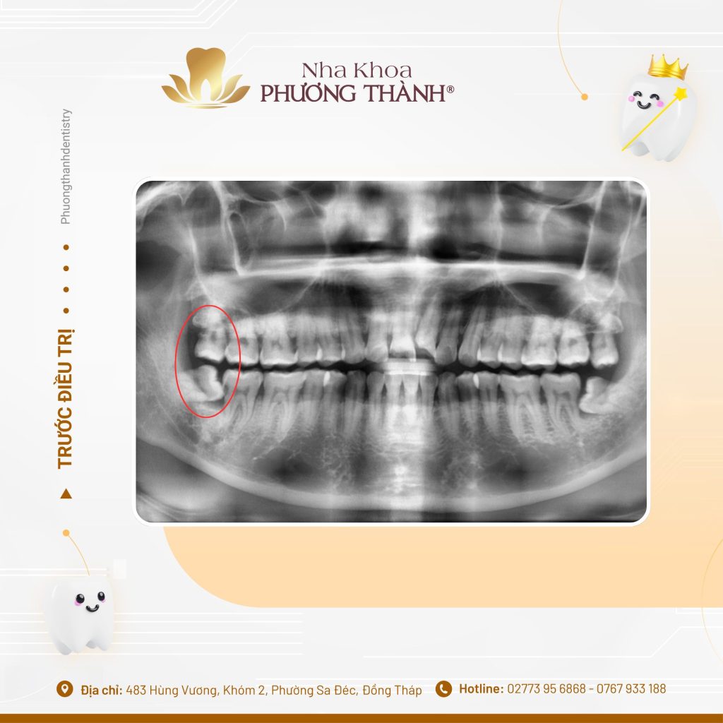 Hướng dẫn trước và sau nhổ răng khôn: Chăm sóc đúng cách để hồi phục thuận lợi