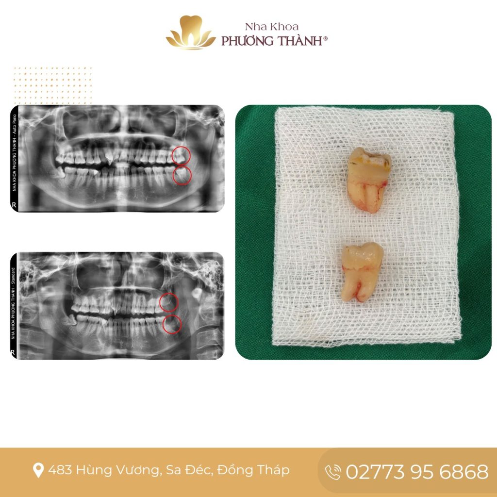 Răng khôn nguy hiểm hơn ở những trường hợp nào?