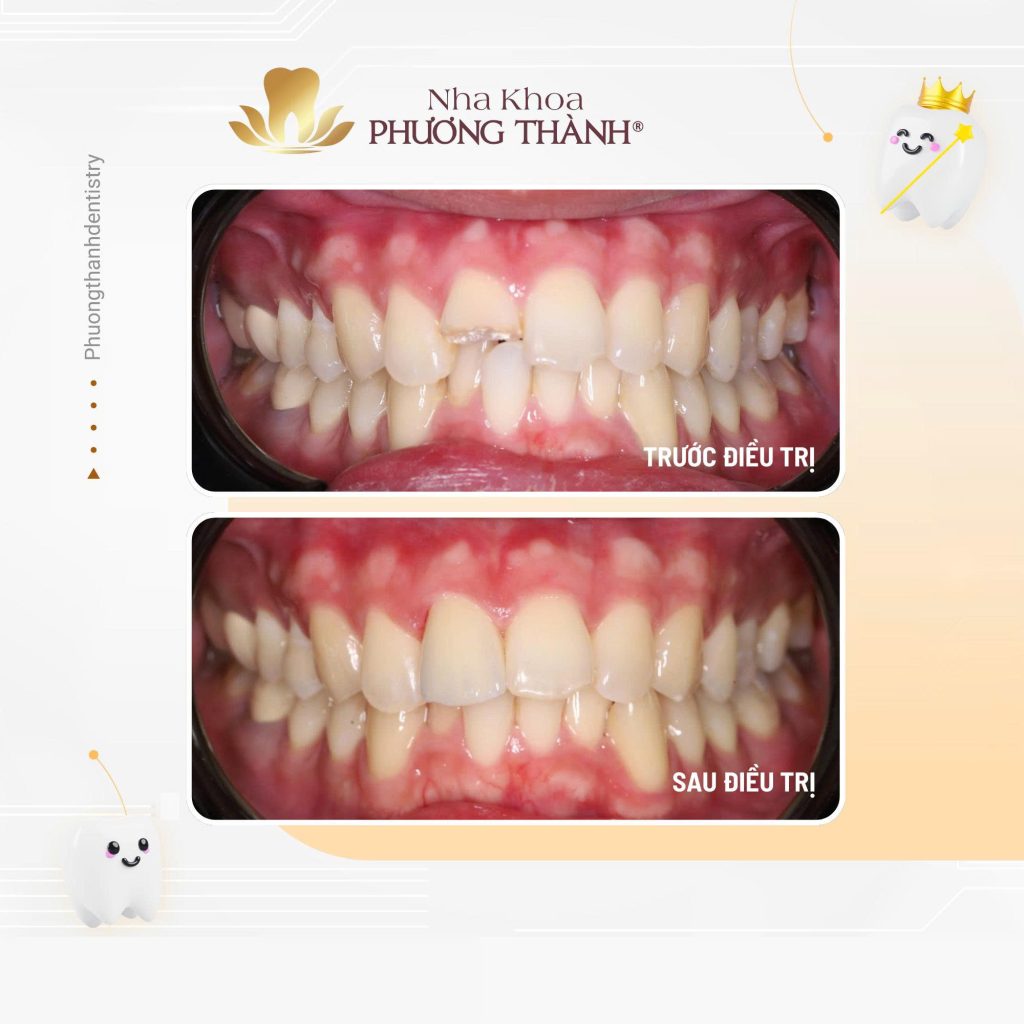 Gãy răng không đồng nghĩa với mất răng