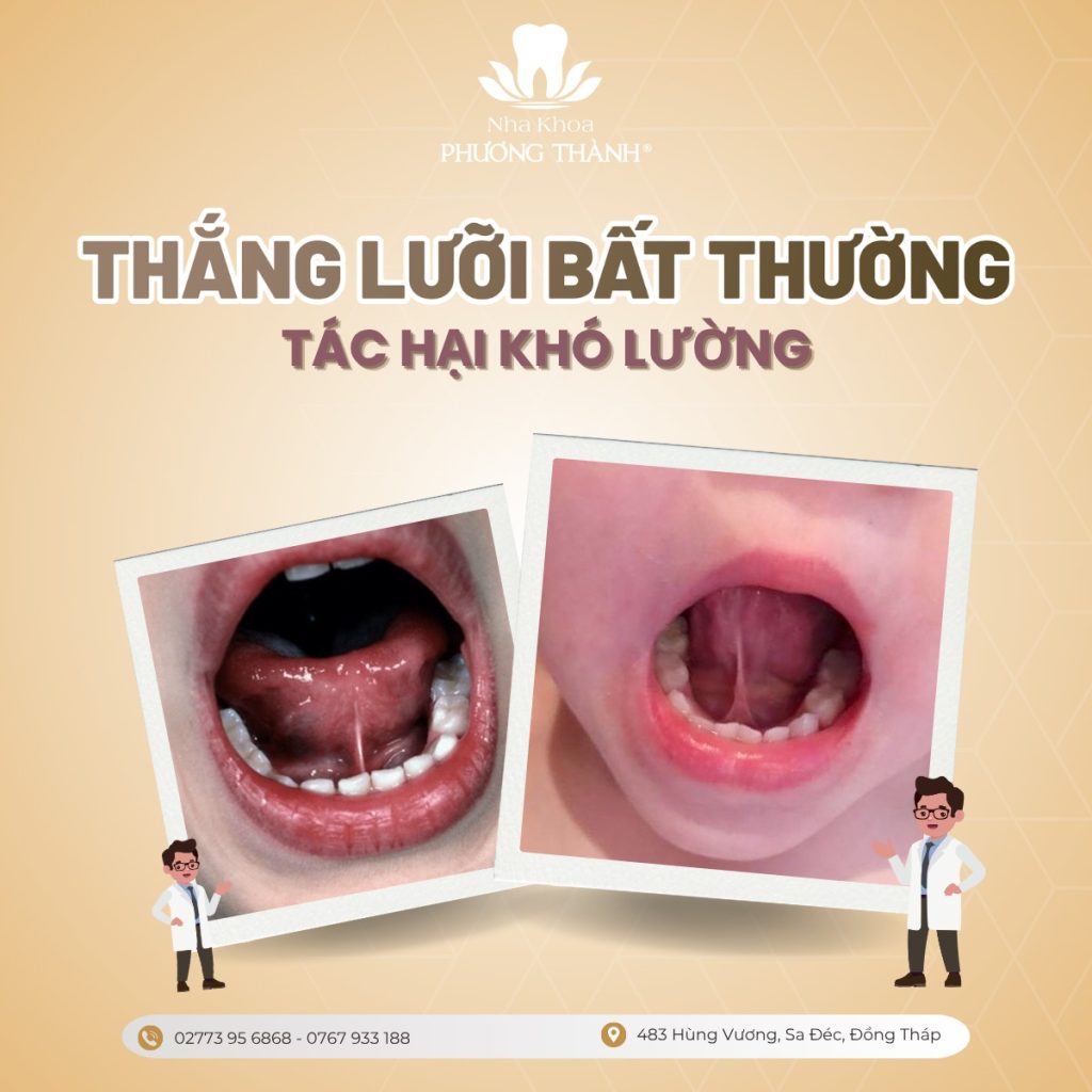 Tác động của thắng lưỡi bất thường ở trẻ: Từ khó bú đến khó phát âm