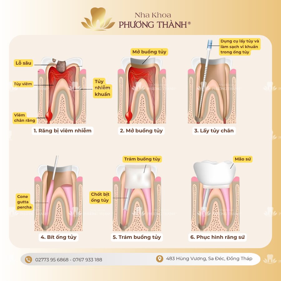 Giải pháp cứu răng thật khỏi nguy cơ mất răng do viêm tủy