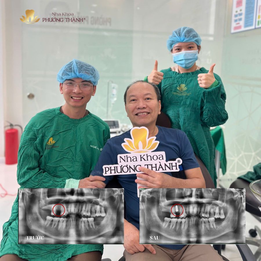 A tooth replacement solution without grinding adjacent teeth at Phuong Thanh Dental Clinic