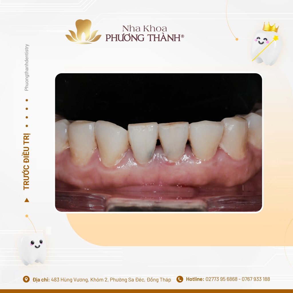 Bọc sứ răng cửa sâu vỡ – Phục hồi tối ưu theo tiêu chuẩn y khoa