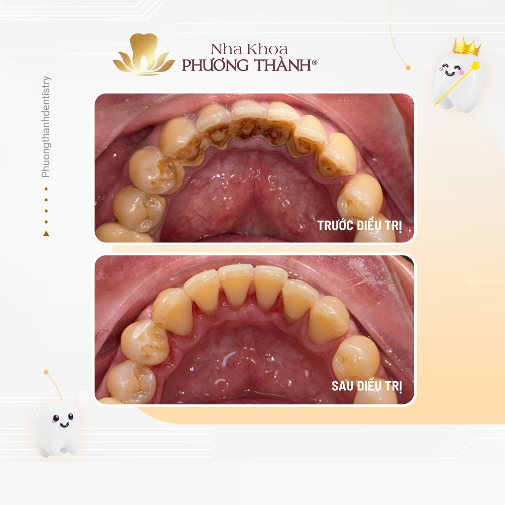 5 vấn đề răng miệng nguy hiểm có thể bắt nguồn từ vôi răng