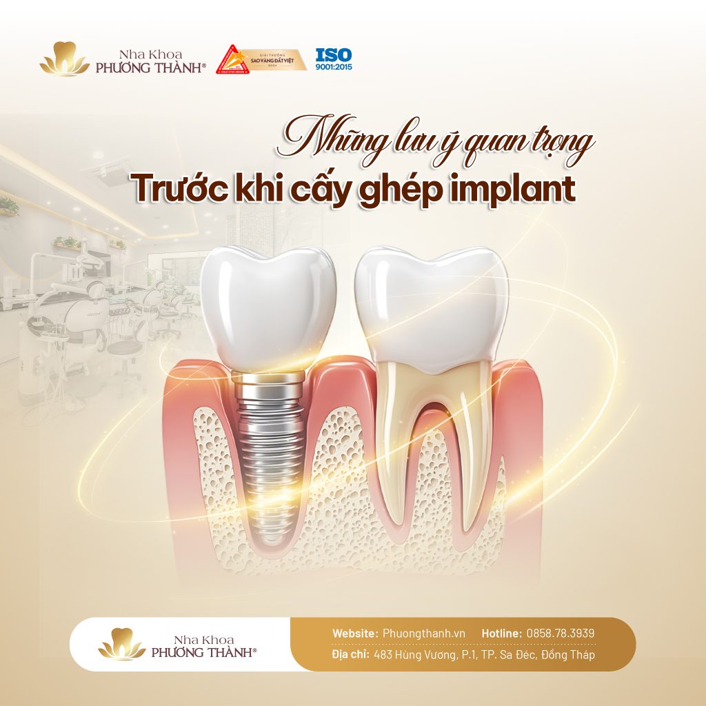 Lưu ý trước khi cấy Implant – Chuẩn bị tốt để phục hồi răng mất hiệu quả