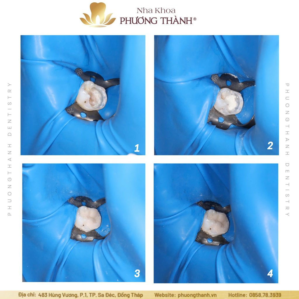 Pulp Treatment for Baby Teeth – Attention to Every Detail for the Future of Permanent Teeth