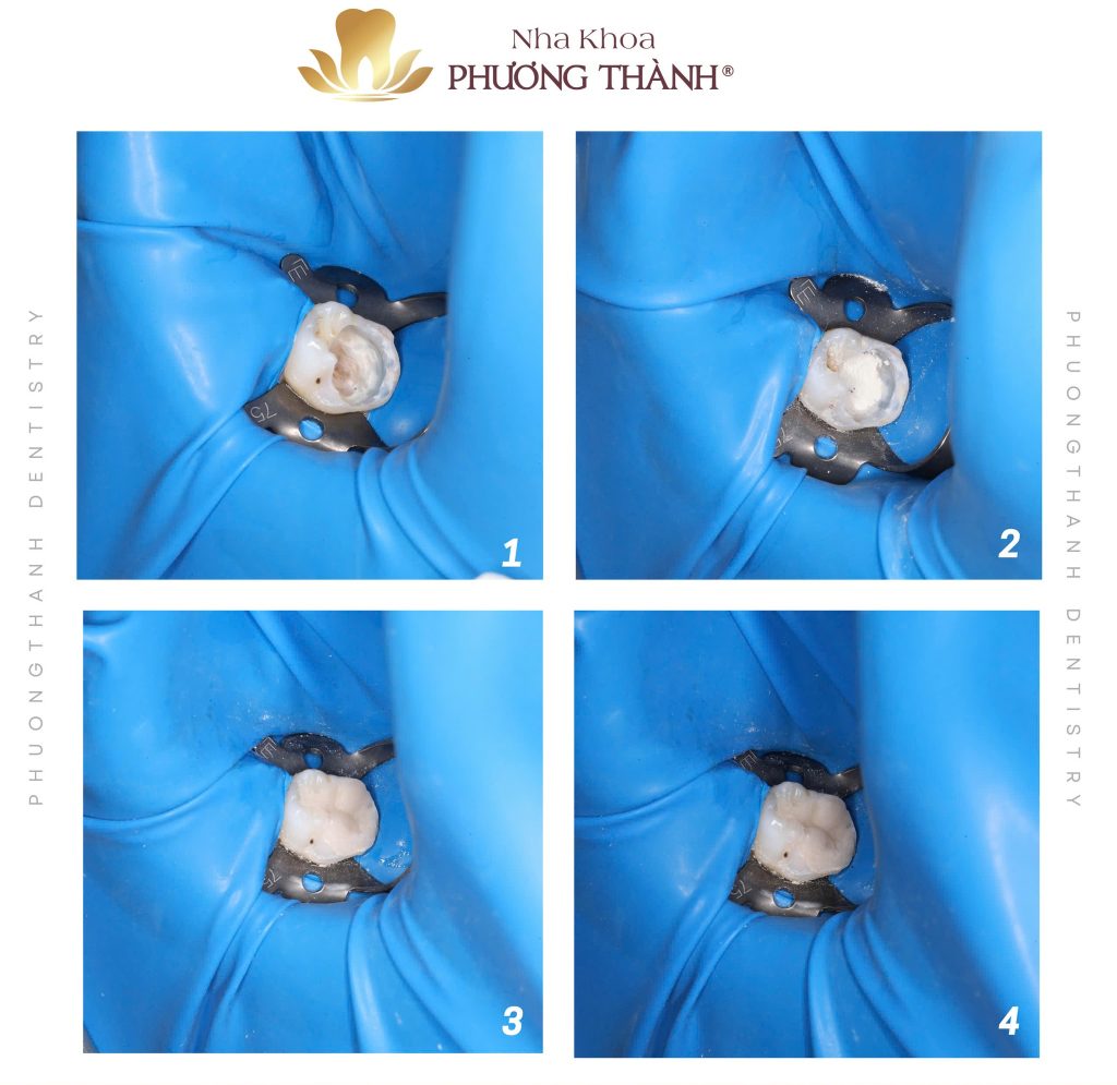 Điều trị tủy răng sữa – Tỉ mỉ trong từng chi tiết vì tương lai răng trưởng thành