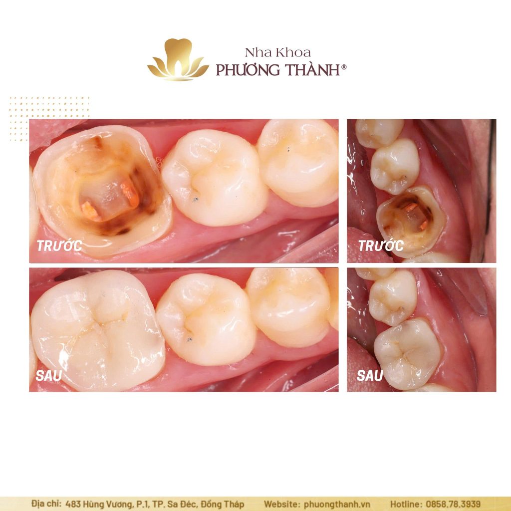 Endocrown for Root Canal–Treated Teeth – Preserving Tooth Structure, Providing Strong Restoration