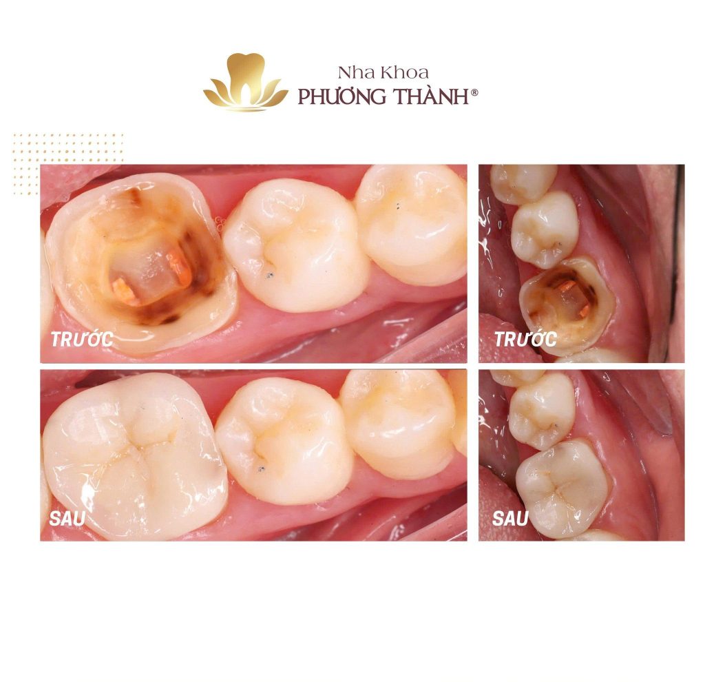 Endocrown cho răng đã điều trị tủy – Bảo tồn mô răng, phục hồi vững chắc