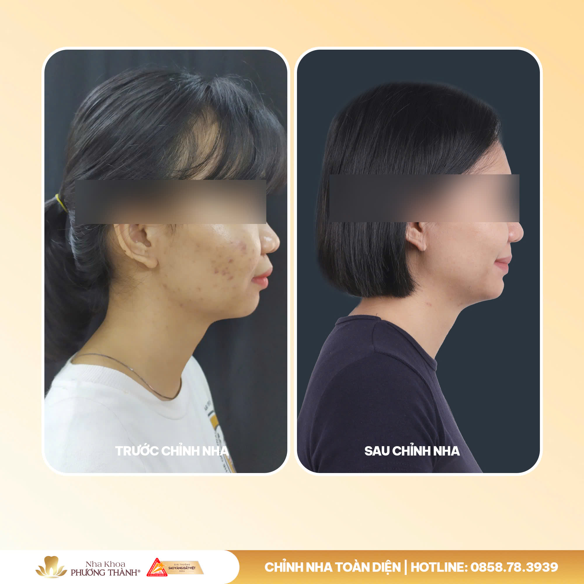 A small change in the teeth – a big difference in the smile and bite