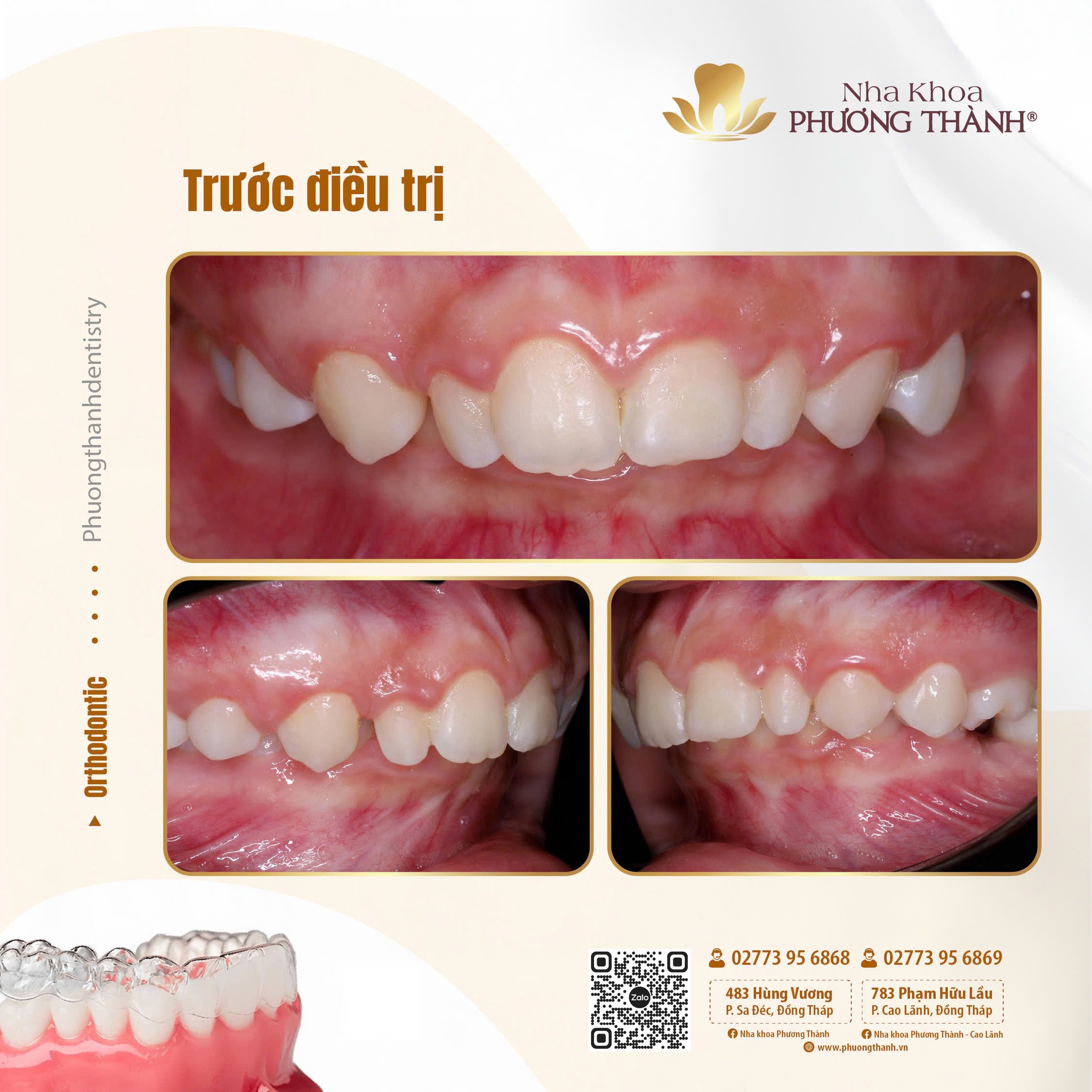 Chỉnh nha khay trong suốt – Tiến độ lâm sàng sau lượt khay chỉnh đầu tiên