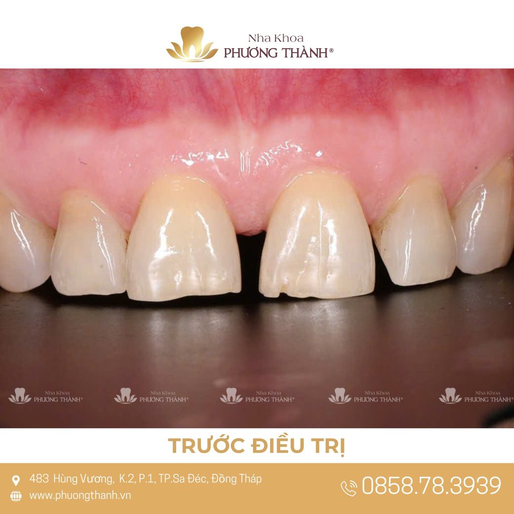 Trám thẩm mỹ khe thưa răng cửa – Giải pháp bảo tồn, cải thiện nụ cười nhẹ nhàng