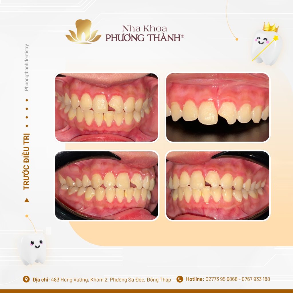 Mẻ răng cửa do tai nạn: Phục hồi thế nào để đảm bảo thẩm mỹ và an toàn?