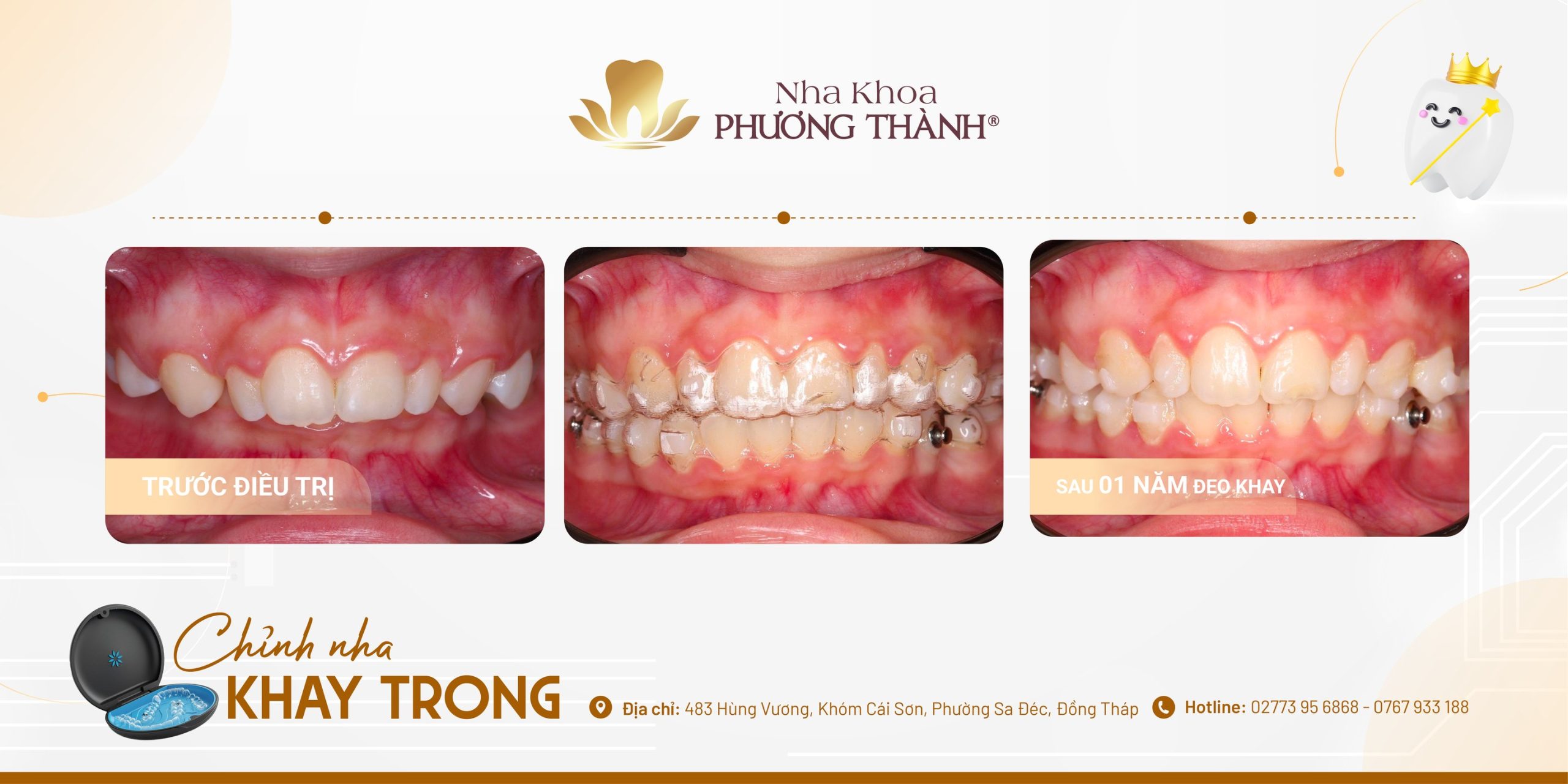 Invisalign Clear Aligner Treatment Case – Noticeable Changes After 1 Year