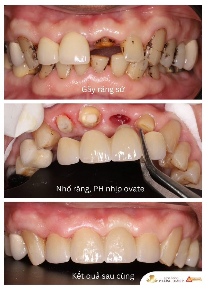 Phục hình răng cửa nhịp ovate – Giải pháp hỗ trợ khôi phục nụ cười tự nhiên