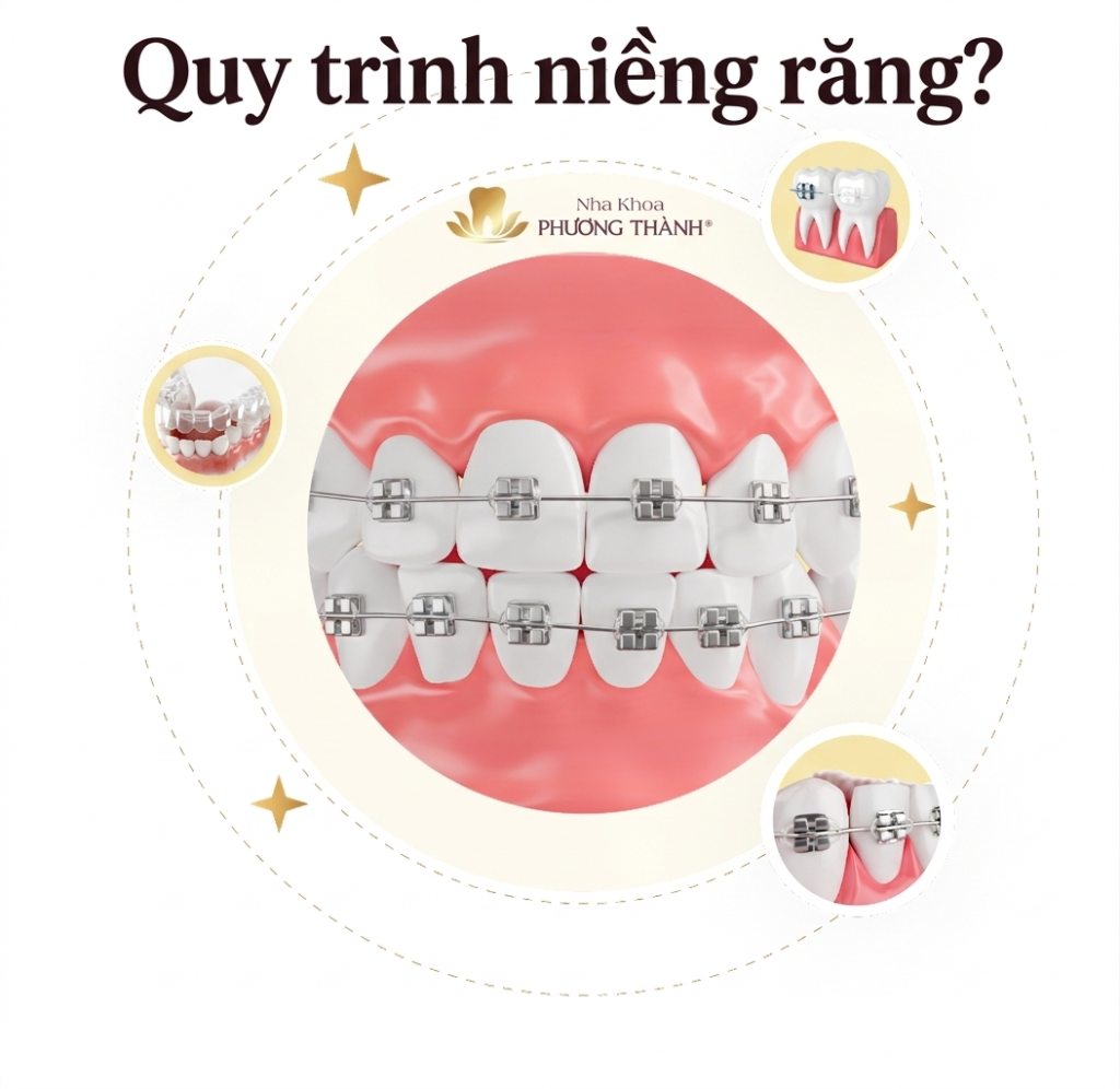 Quy trình niềng răng diễn ra thế nào? Có bao nhiêu giai đoạn niềng răng