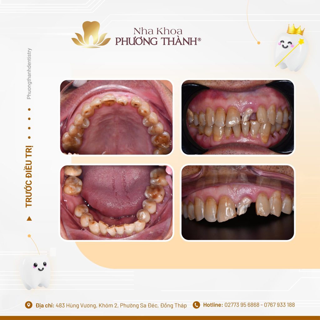 Restoration of a Vertically Cracked Front Tooth – A Conservative Solution for Aesthetics and Function