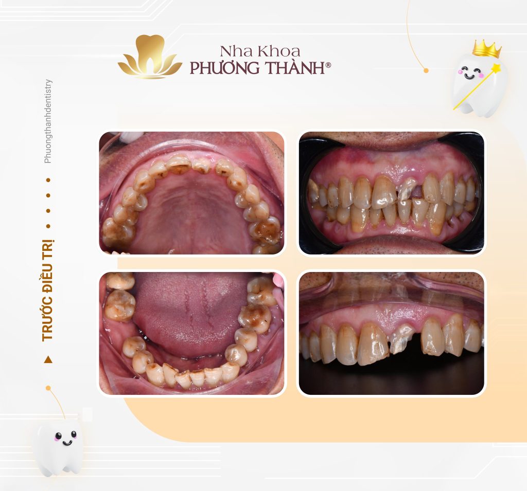 Phục hồi răng cửa bị nứt dọc – Giải pháp bảo tồn thẩm mỹ và chức năng