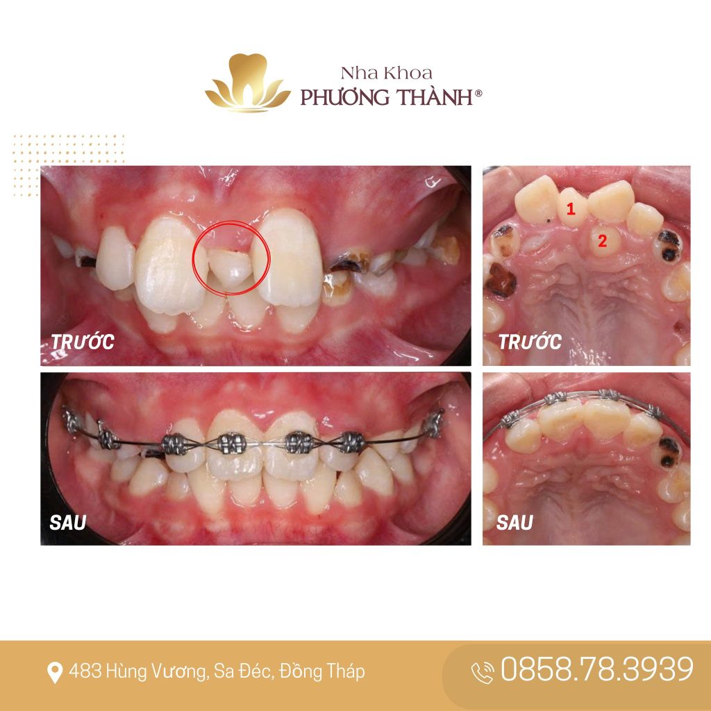 Răng dư ở trẻ – Vì sao nên khám sớm?