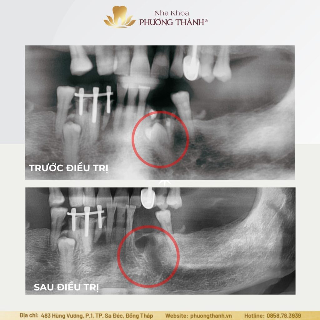 Impacted Teeth and Embedded Teeth: Even Without Pain, They May Still Carry Hidden Risks