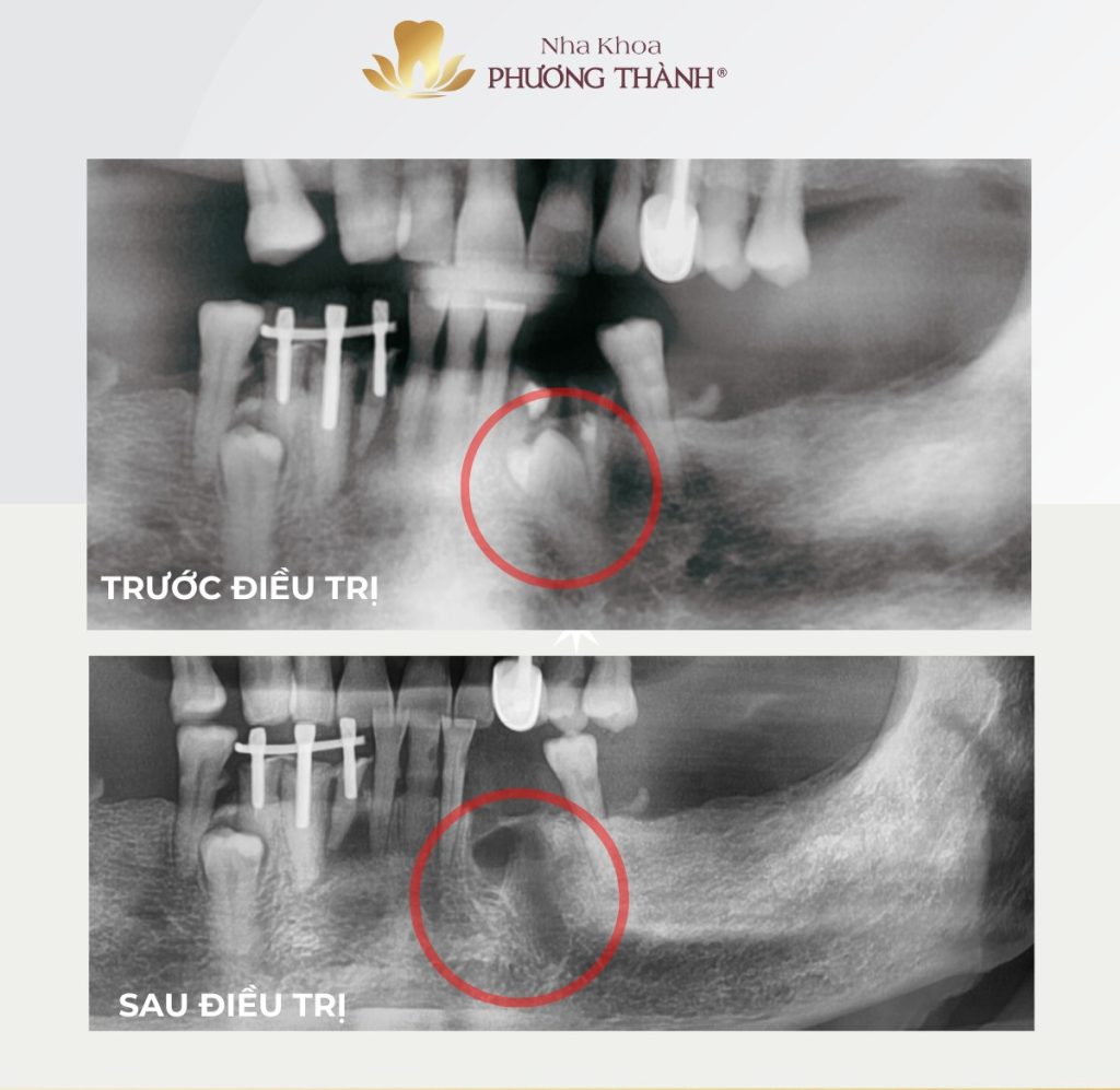 Răng mọc kẹt – răng mọc ngầm: Không đau vẫn có thể tiềm ẩn nhiều nguy cơ