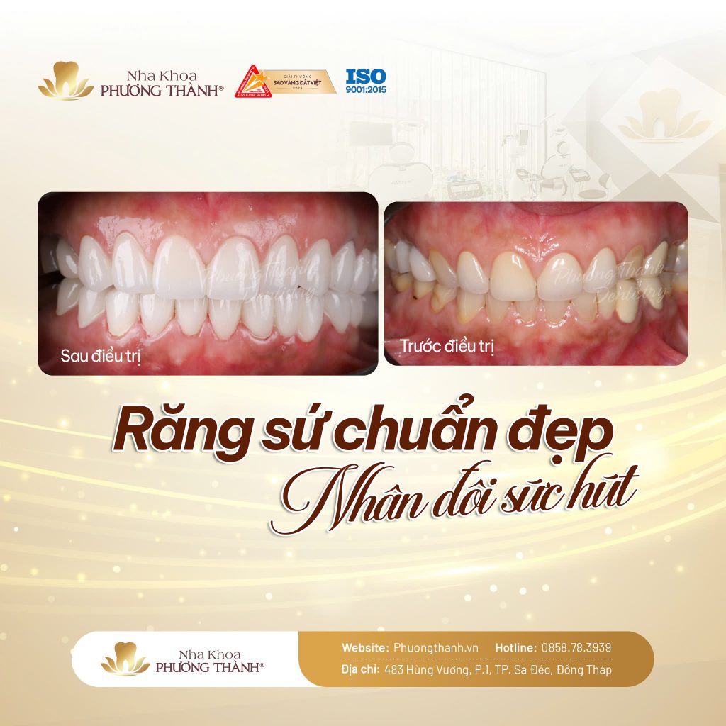 Răng sứ thẩm mỹ – Giải pháp cải thiện nụ cười hài hòa và tự nhiên