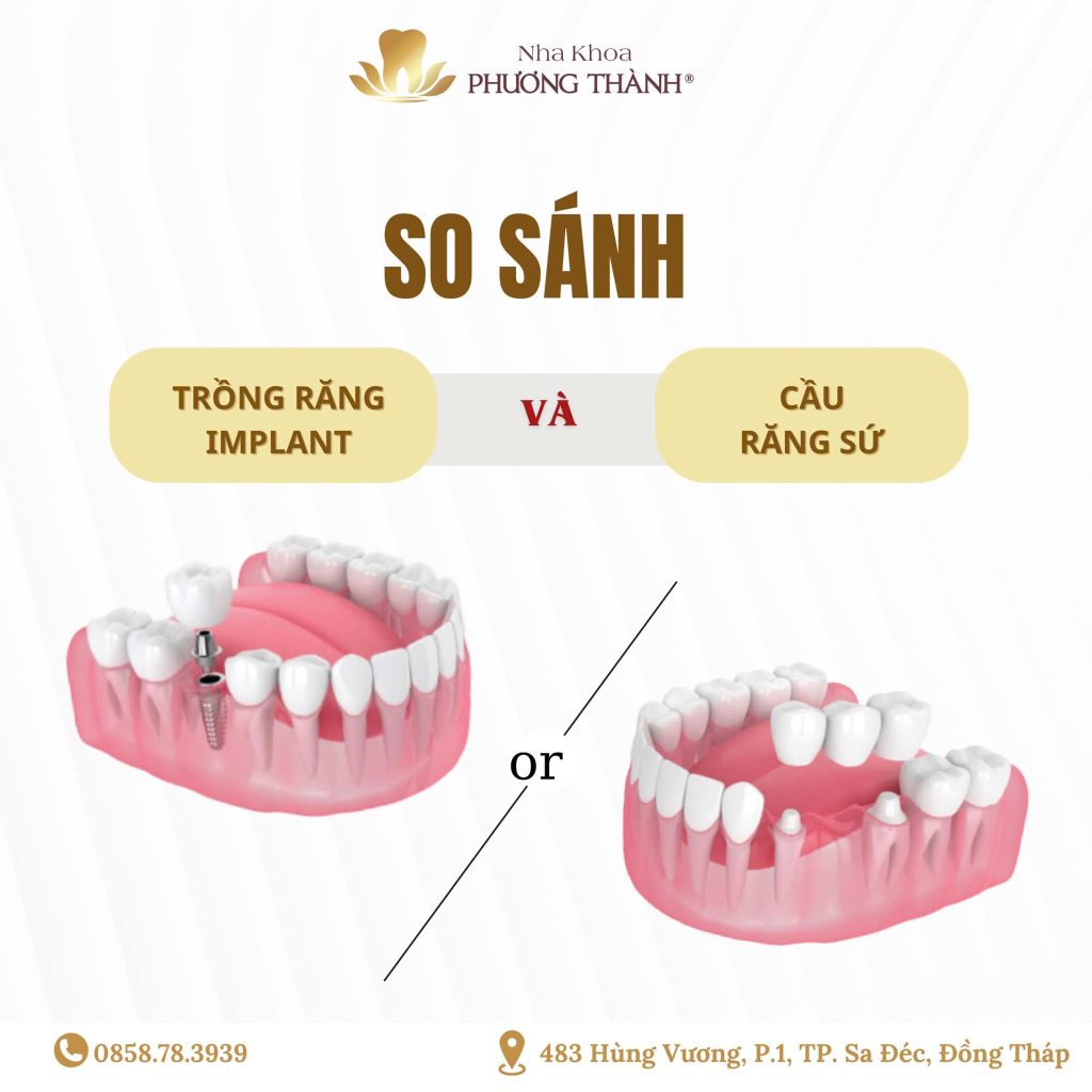 So sánh cầu răng sứ và trồng răng Implant