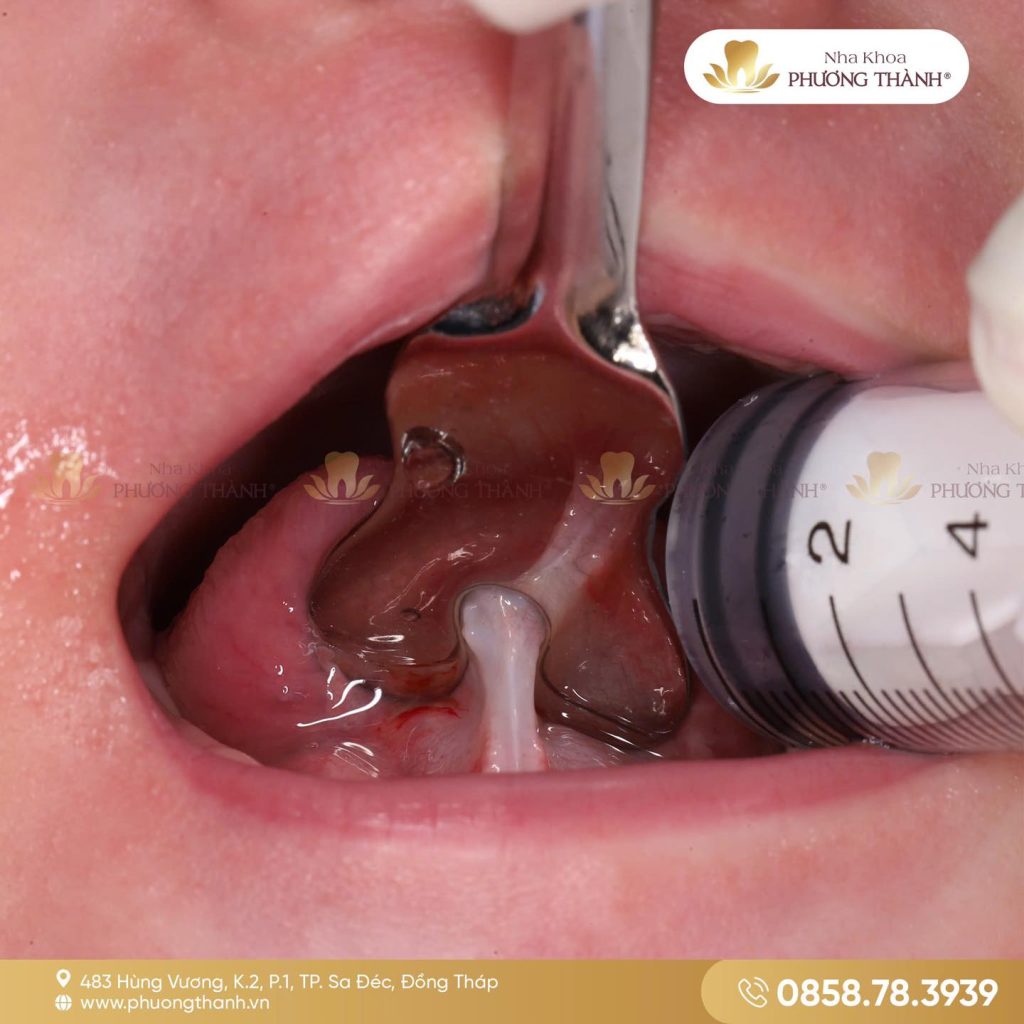 Như thế nào là dính thắng lưỡi?