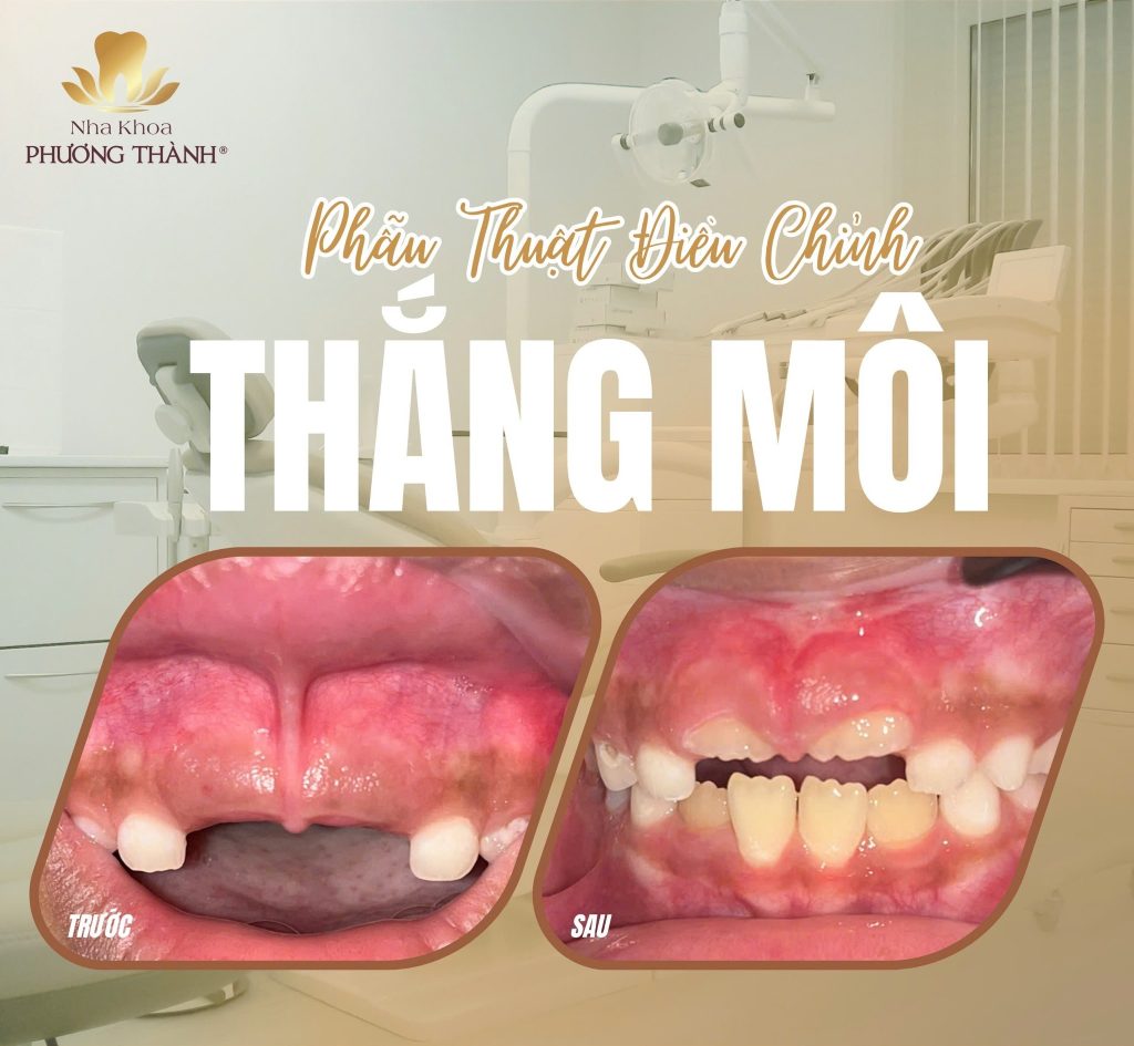 Cắt thắng môi – Hỗ trợ bộc lộ thân răng lâm sàng