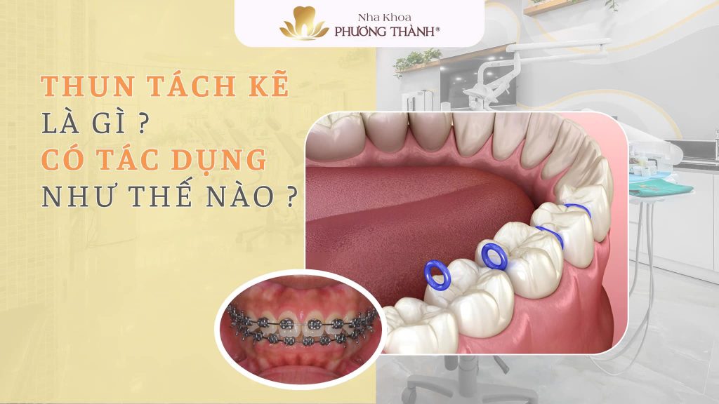 Thun tách kẽ là gì? Có tác dụng như thế nào trong niềng răng?