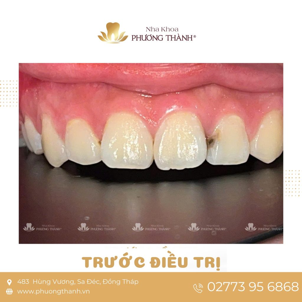 Trám răng thẩm mỹ – Giải pháp phục hồi nhanh gọn, tự nhiên và bền chắc