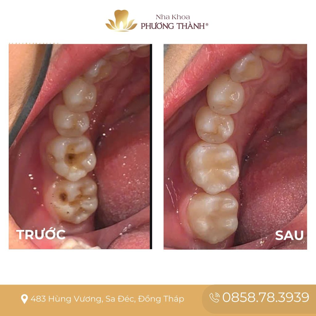 Occlusal Surface Reconstruction for Tooth No. 6 – Not Just Restoration, but Precision in Every Detail