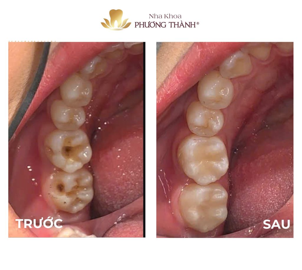 Trám tái tạo mặt nhai răng số 6 – Không chỉ là phục hồi, mà còn là sự chính xác trong từng chi tiết