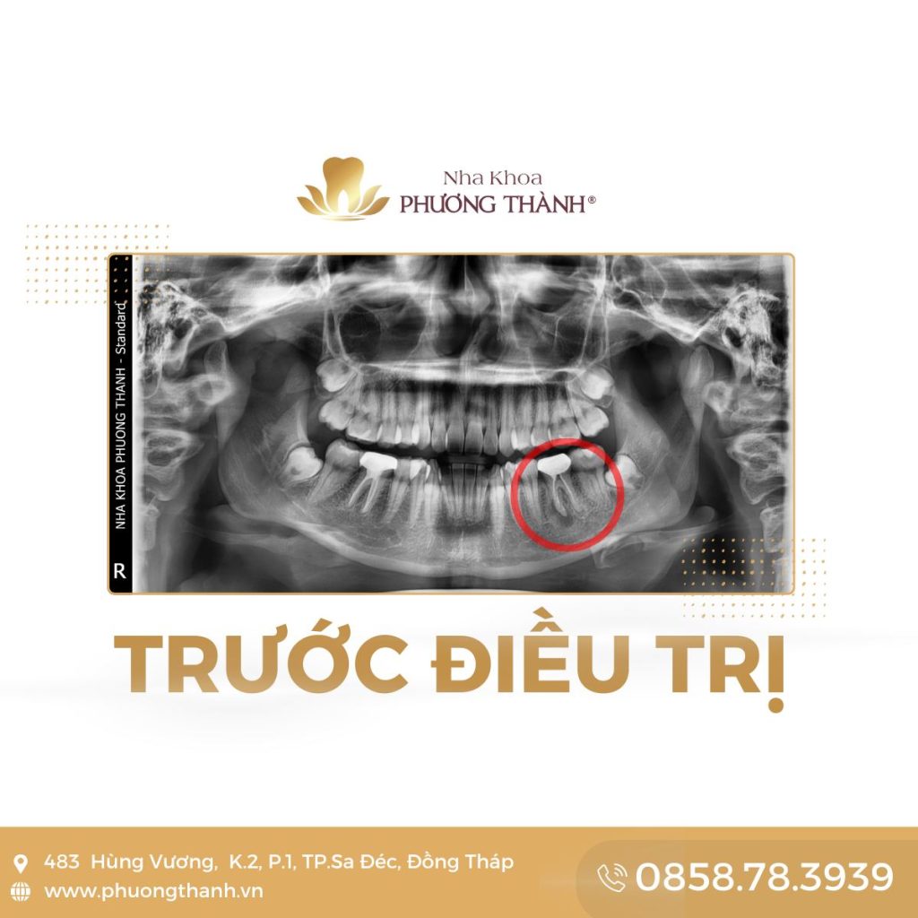 Khắc phục hậu quả sau điều trị tủy và làm răng sứ chưa phù hợp