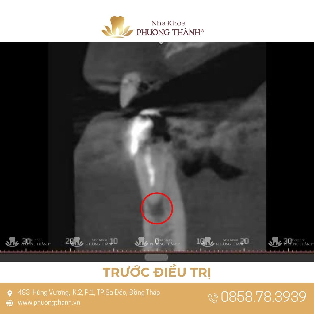 Still in Pain After a Root Canal? – When Is Endodontic Retreatment Needed?