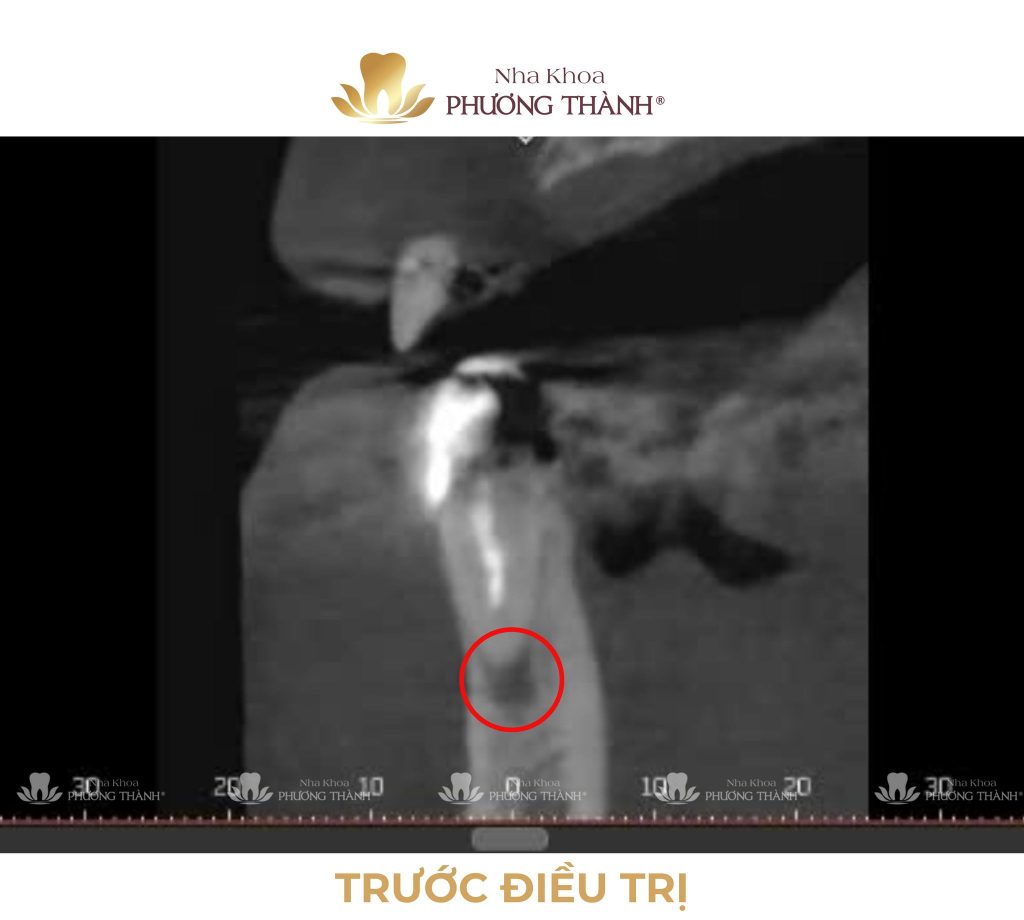 Đã điều trị tủy nhưng vẫn còn đau – Khi nào cần điều trị lại nội nha?