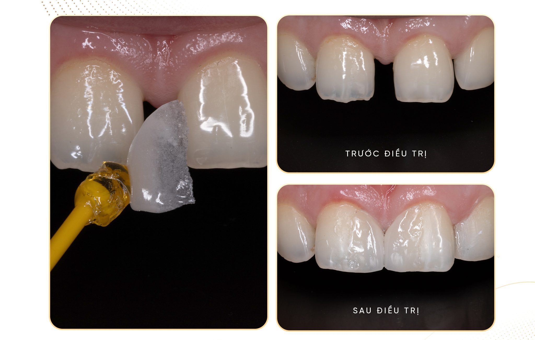 Dán sứ Veneer là gì?