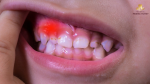 Gingivitis in children: What is it? Causes, signs, and treatment methods.