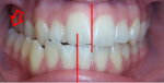 Lệch khớp cắn là gì? Các thông tin về lệch khớp cắn bạn cần biết.