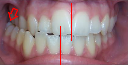 Lệch khớp cắn là gì? Các thông tin về lệch khớp cắn bạn cần biết.
