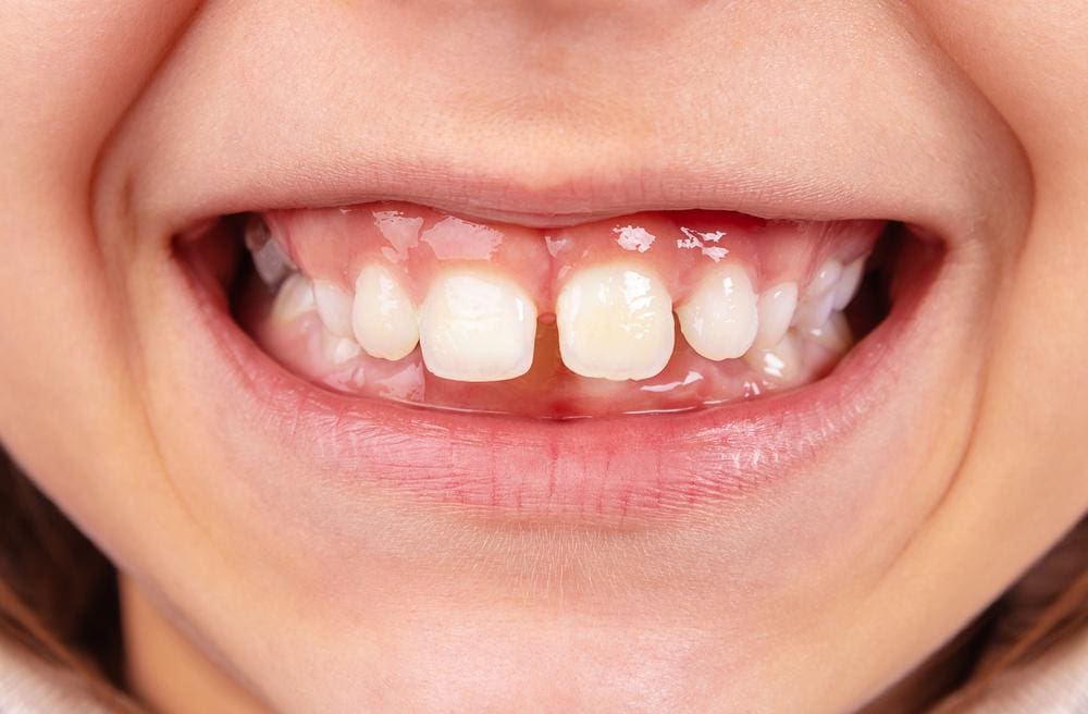 Răng thưa là gì? Những cách chữa răng thưa hiệu quả.