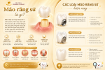 Mão răng sứ là gì? Các loại mão răng sứ hiện nay