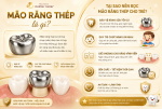Mão răng thép là gì? Tại sao nên bọc mão răng thép cho trẻ.