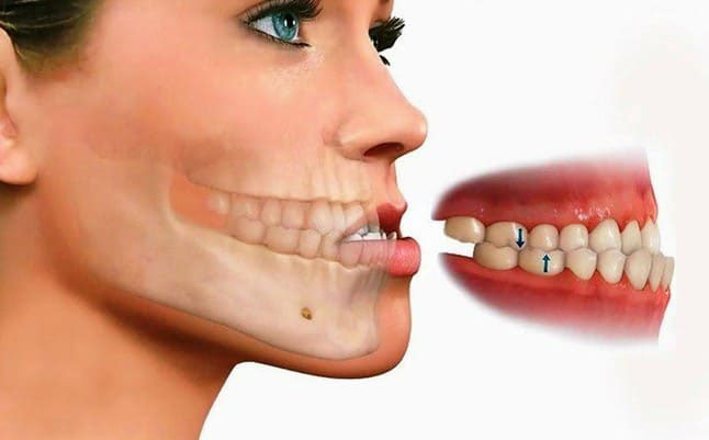 Răng móm là răng như thế nào? Dấu hiệu, nguyên nhân và cách khắc phục răng móm