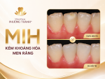 MIH – “Kẻ Thầm Lặng” Gây Ảnh Hưởng Đến Nụ Cười Của Trẻ